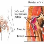 Hip pain when walking here's how to fix it!