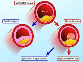 what is arteriosclerotic heart disease arterial plaque build up