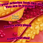 Artery plaque image