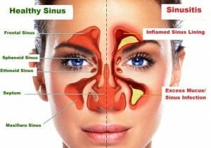 sinusitis