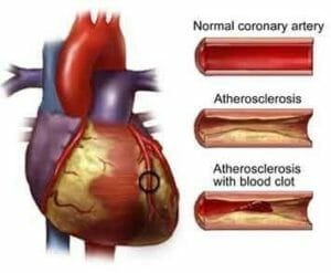 atherosclerosis