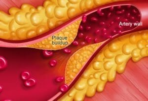 What causes inflammation in the arteries 