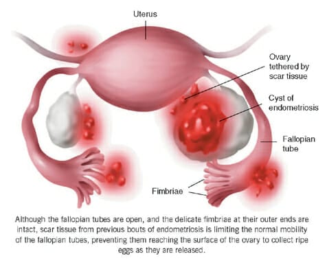 Serrapeptase: Ultimate Natural Treatment for Endometriosis?