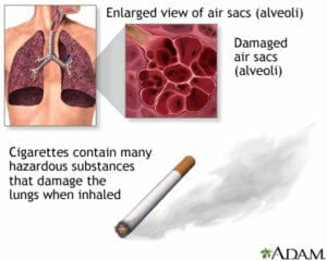 Best treatments for COPD