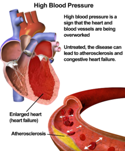 Blausen high blood prressure