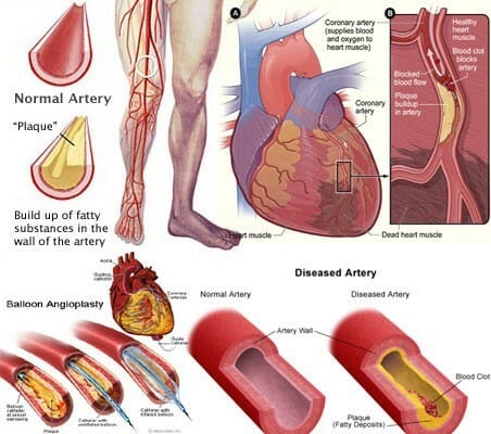 Symptoms blocked arteries 