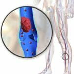 Nattokinase dissolve blood clots