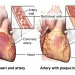 Can Natural Treatment Help With Cardiovascular Disease?