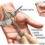 Carpal tunnel surgery