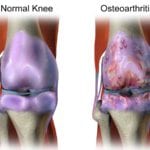  best natural remedies osteoarthritis 