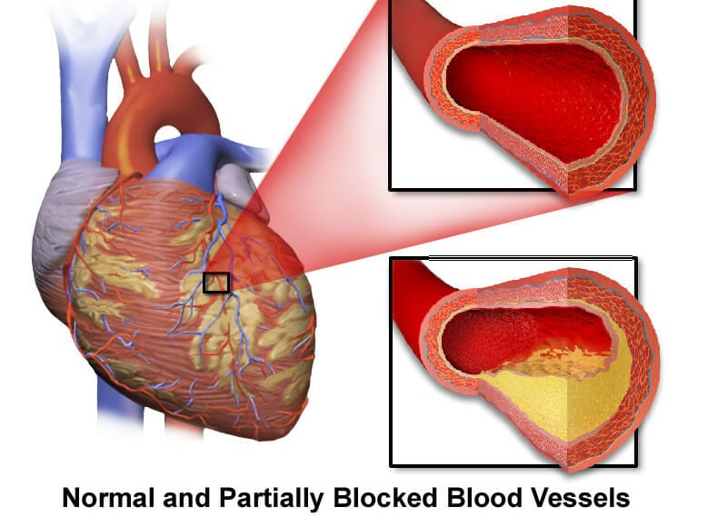 blocked heart artery