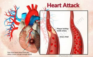 Heart attack image