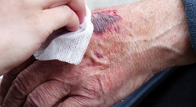 Wound healing