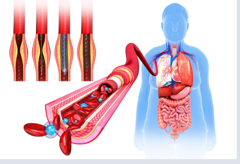 Arterial calcification