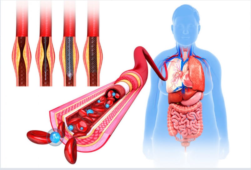 Calcification of arteries and heart health